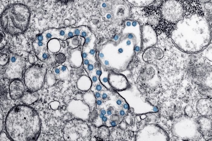 Microscopic slide of COVID-1 coronavirus